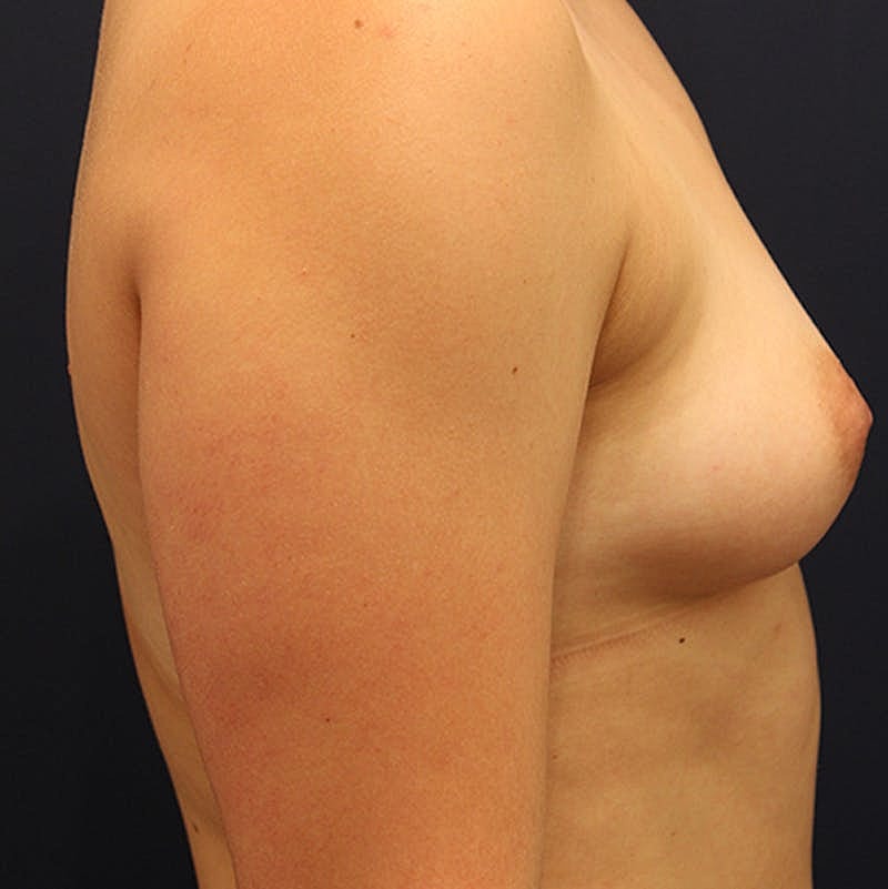 Breast Fat Transfer Before & After
