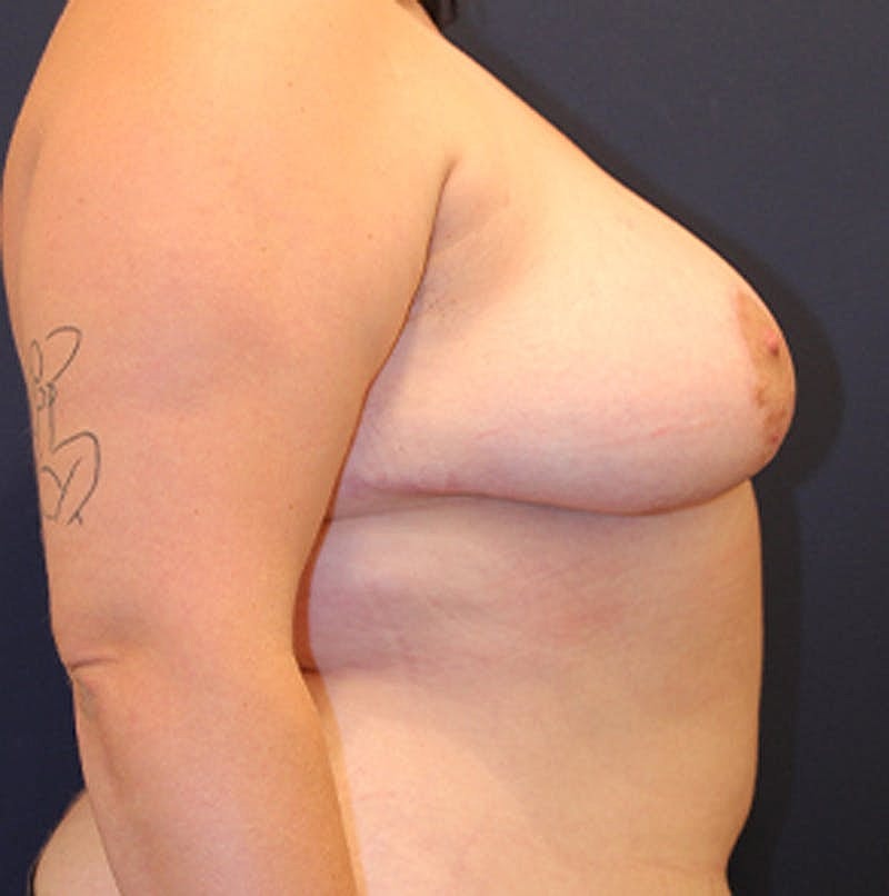 Breast Asymmetry Before & After