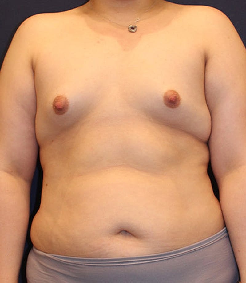 Breast Asymmetry Before & After