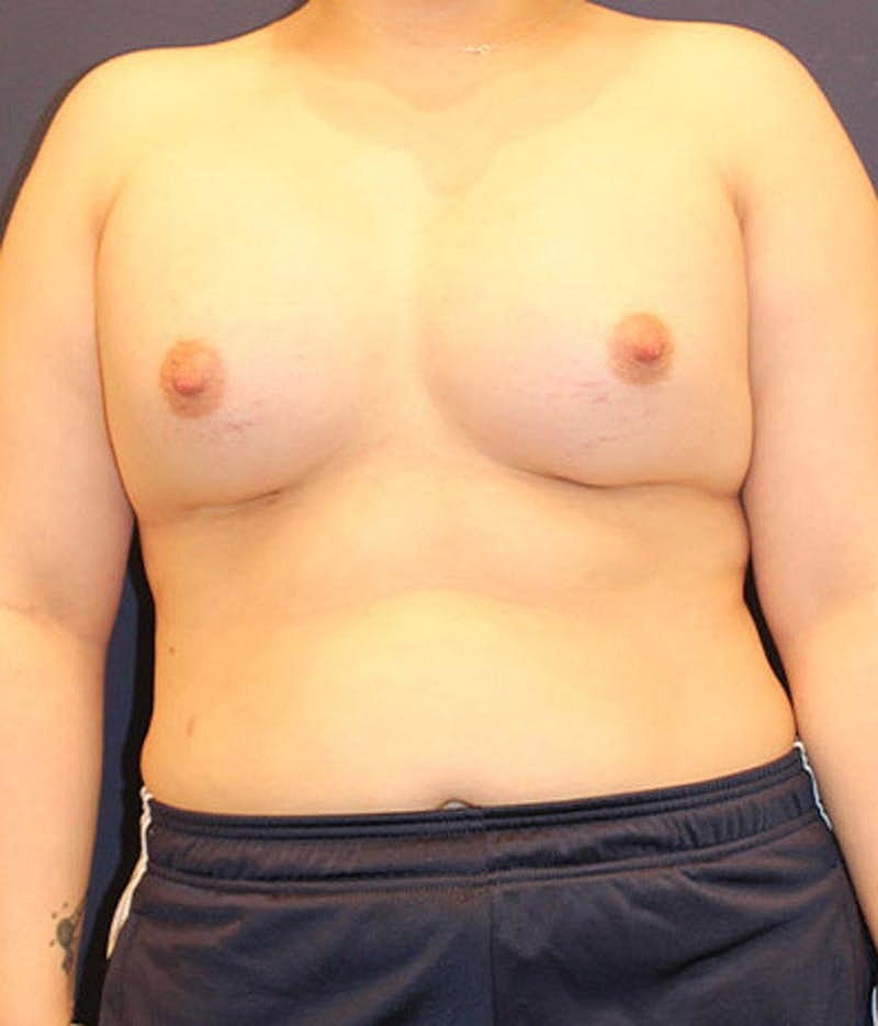 Breast Asymmetry Before & After