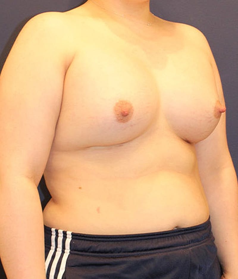 Breast Asymmetry Before & After