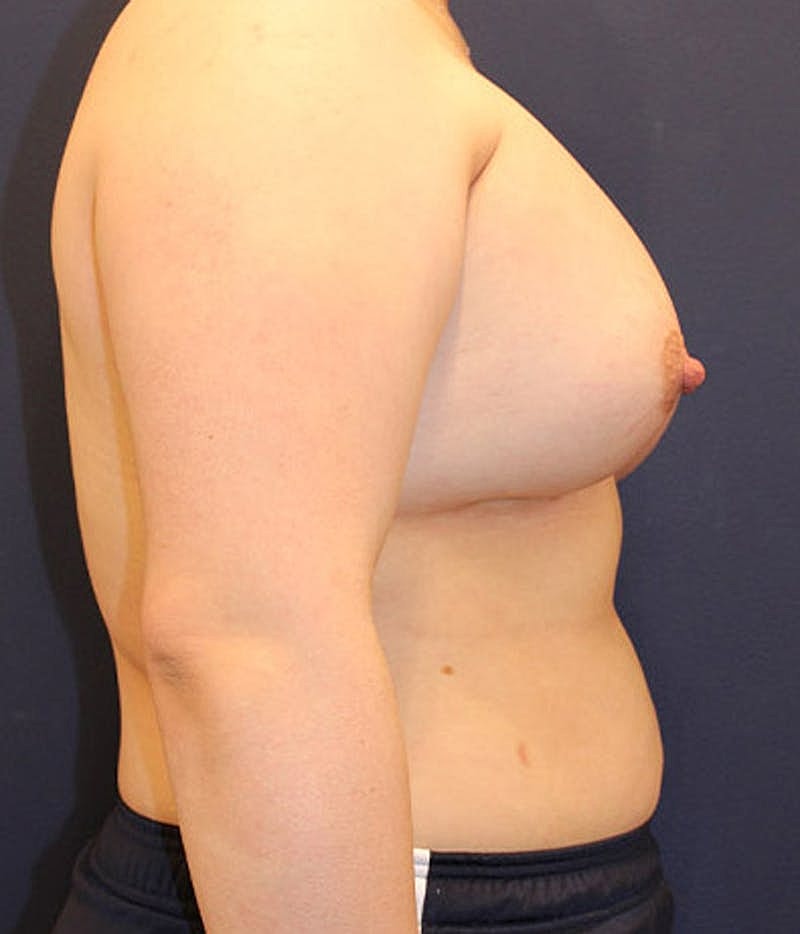 Breast Asymmetry Before & After