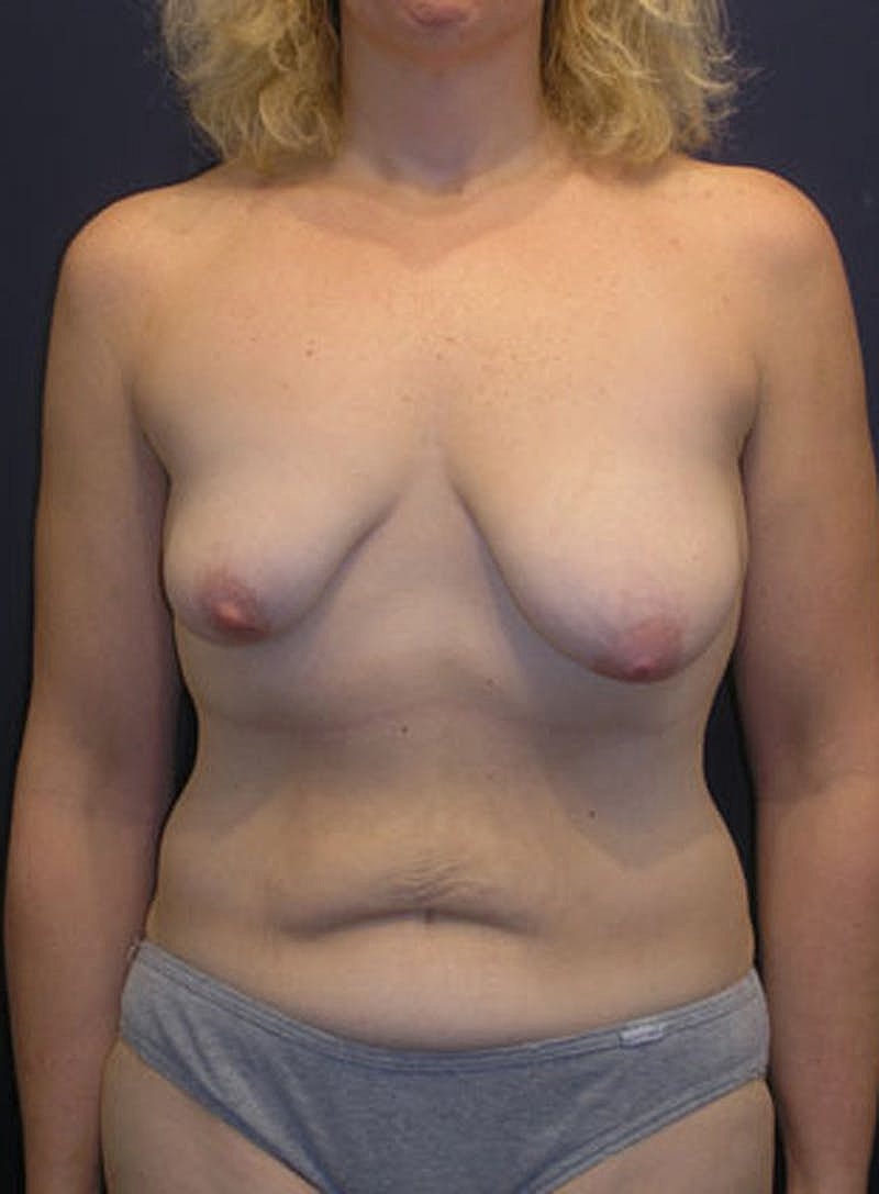 Breast Asymmetry Before & After