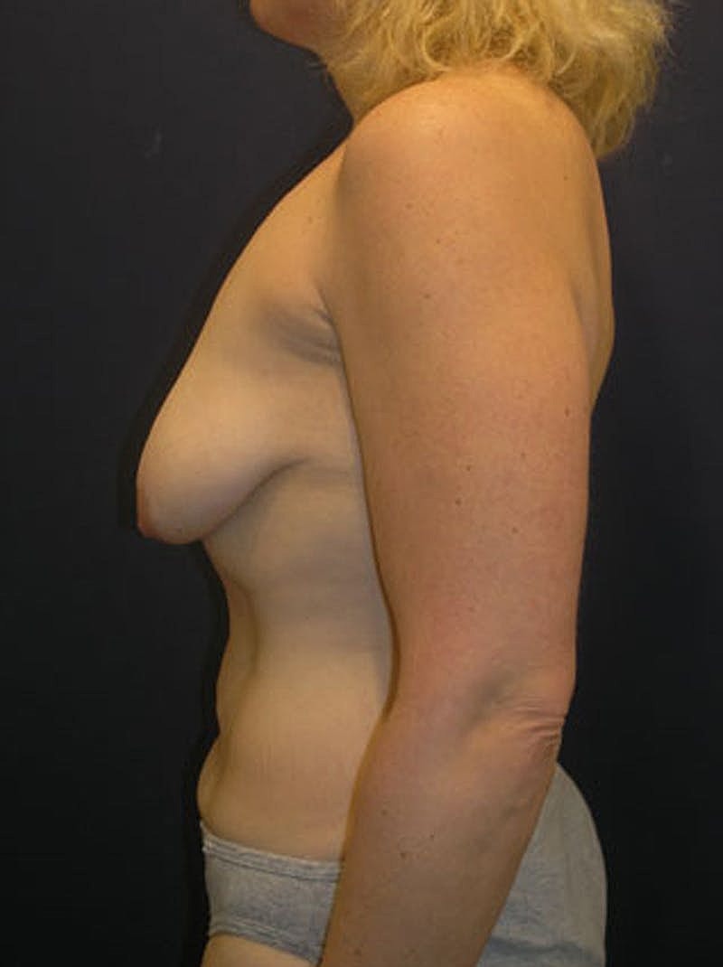 Breast Asymmetry Before & After