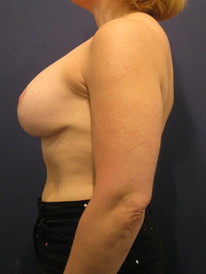 Breast Asymmetry Before & After