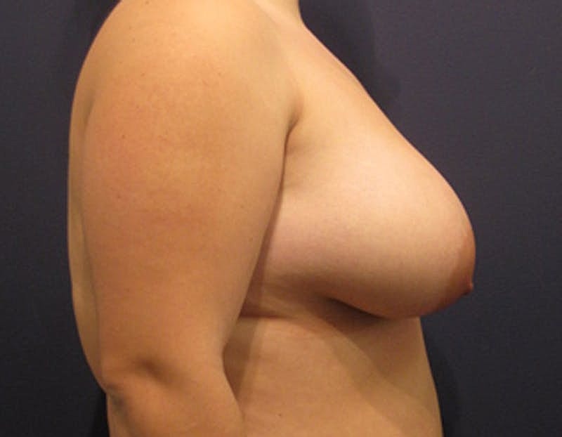 Breast Asymmetry Before & After