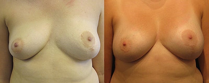 Breast Asymmetry Before & After