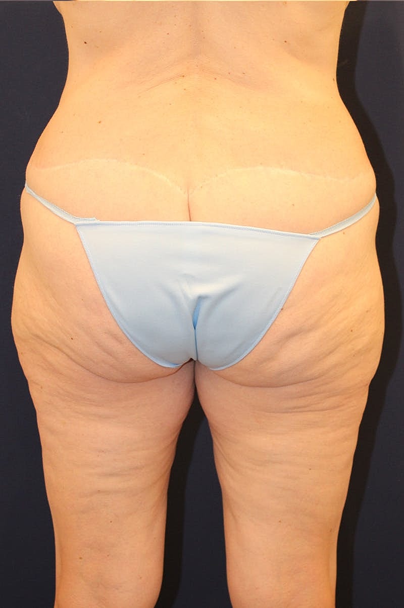 Thigh Lift Before & After