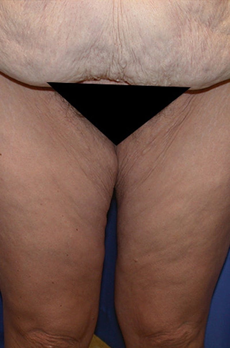 Thigh Lift Before & After