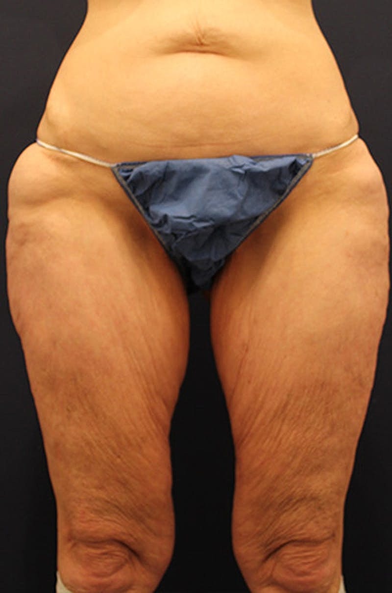 Thigh Lift Before & After