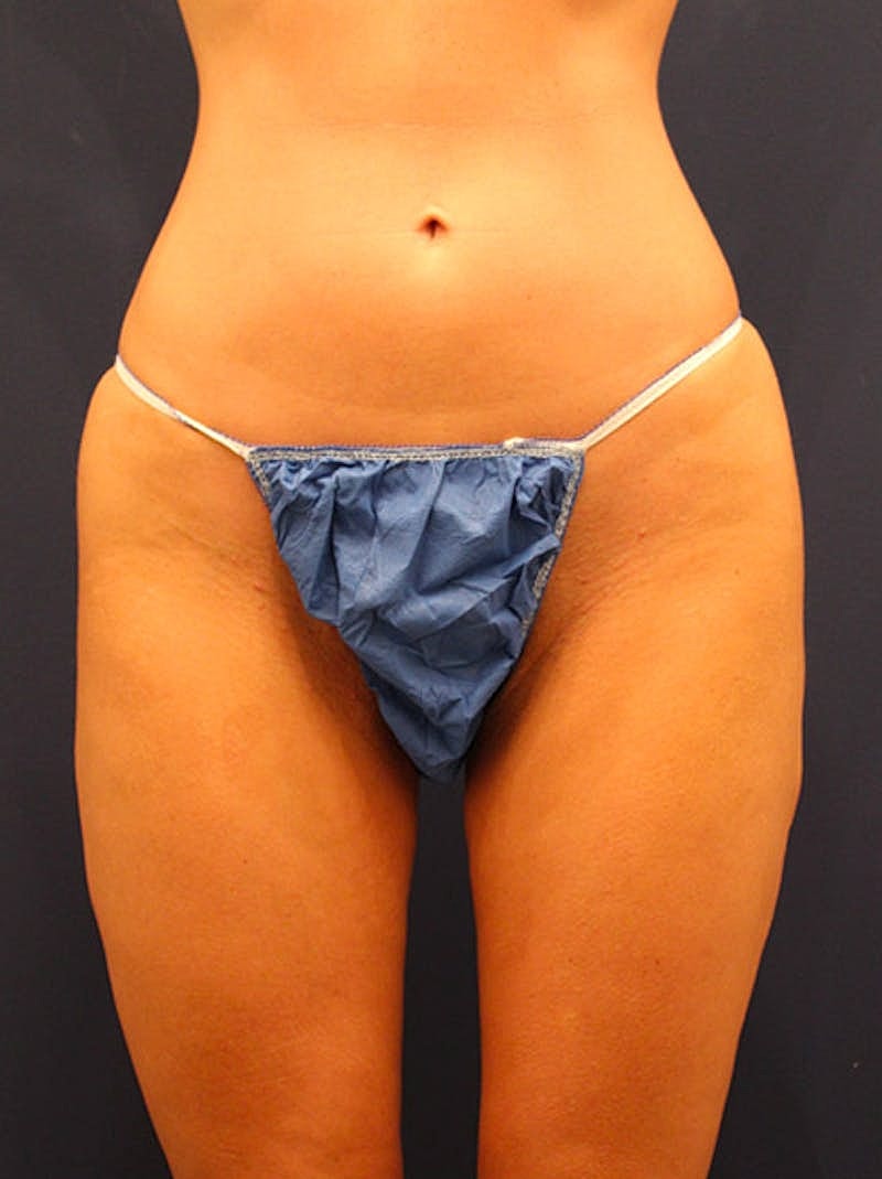 Thigh Lift Before & After