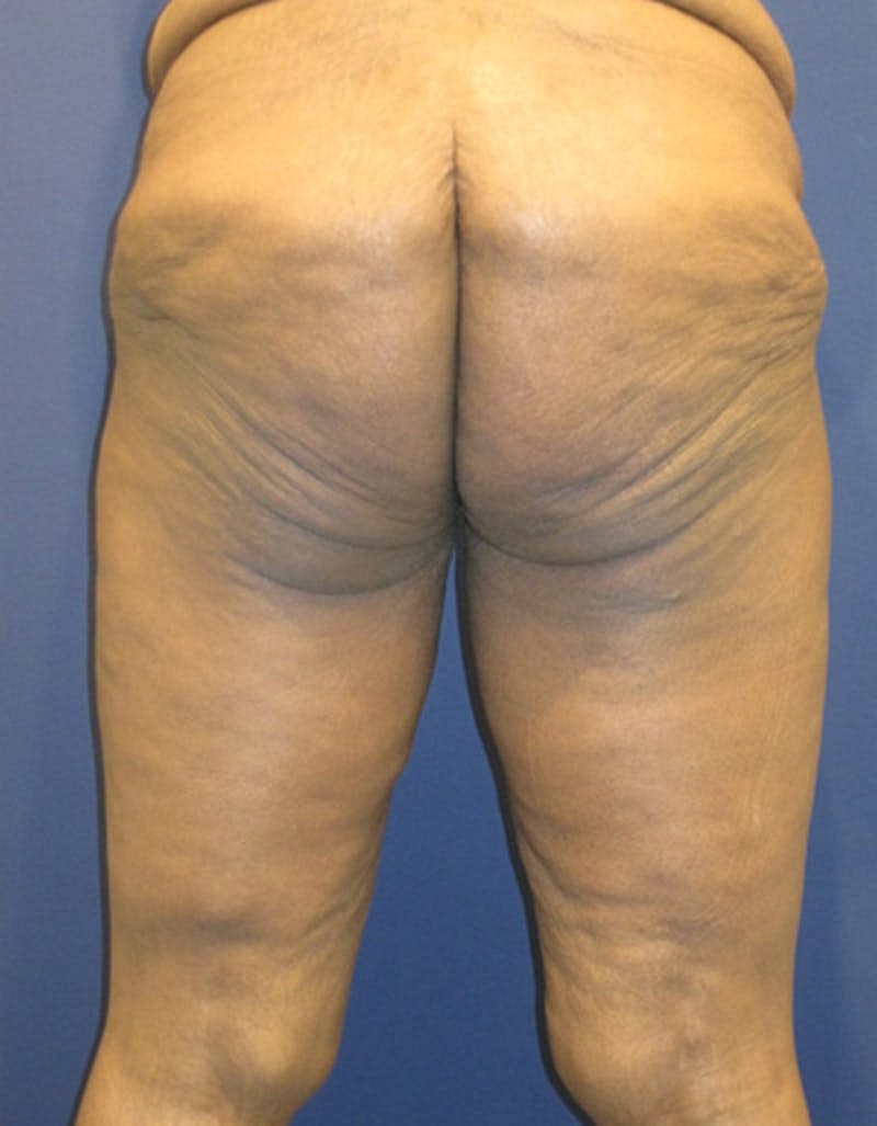 Thigh Lift Before & After