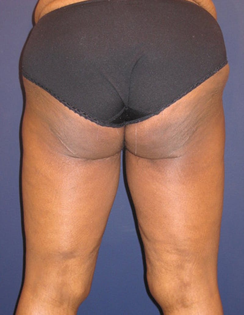 Thigh Lift Before & After