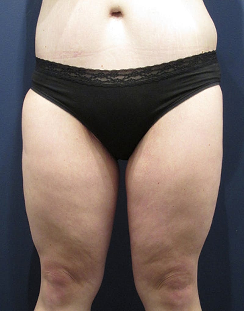 Thigh Lift Before & After