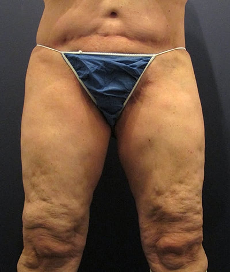 Thigh Lift Before & After
