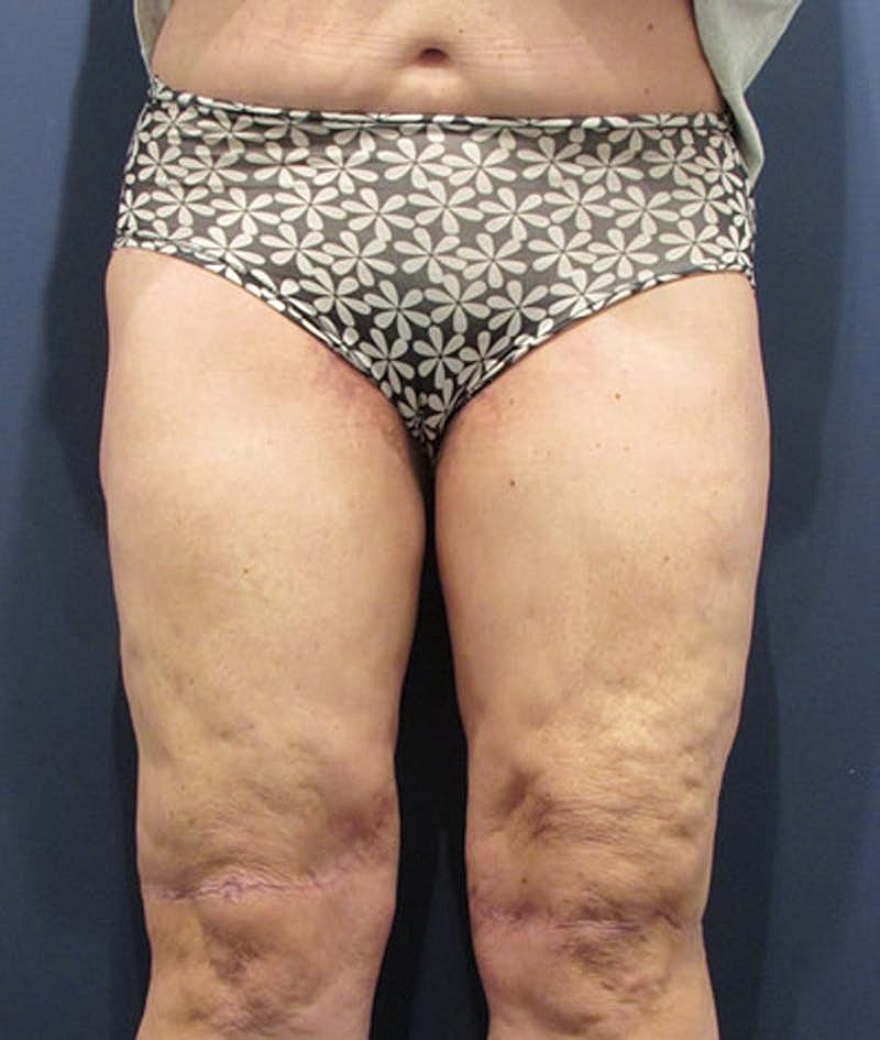 Thigh Lift Before & After