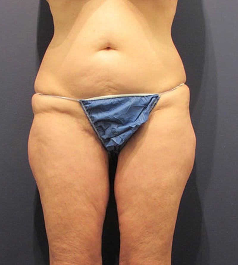 Thigh Lift Before & After