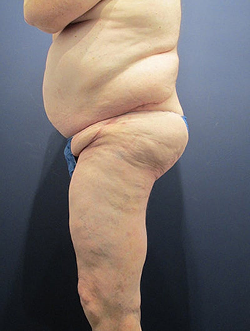 Thigh Lift Before & After