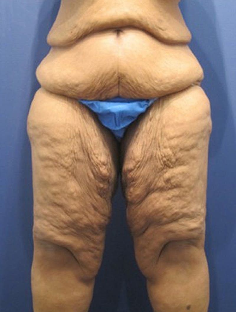 Thigh Lift Before & After