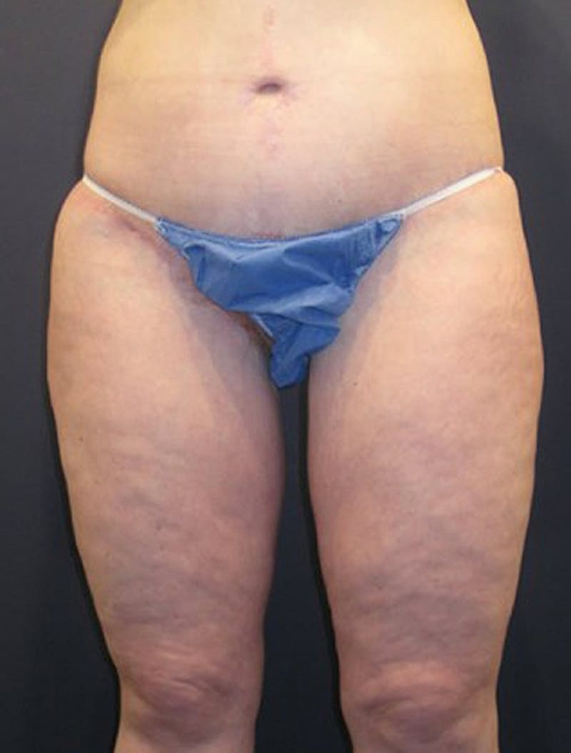 Thigh Lift Before & After