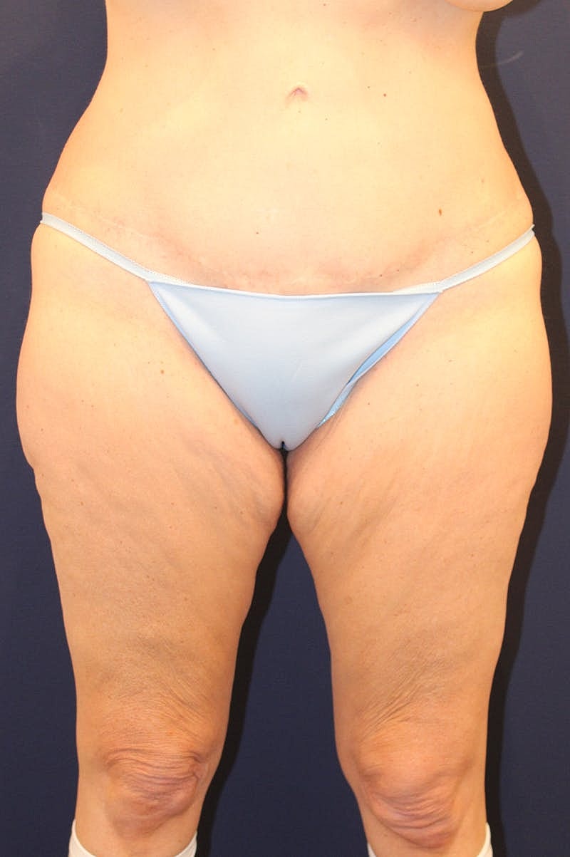 Thigh Lift Before & After