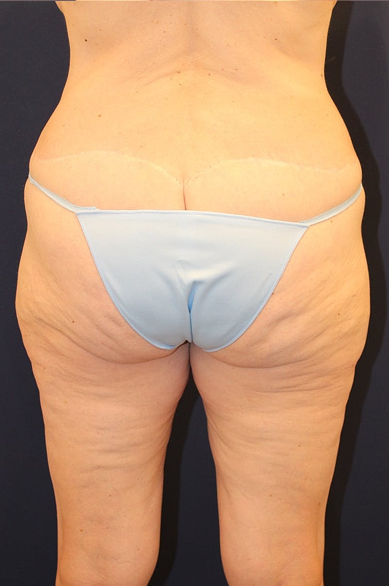 Thigh Lift Before & After