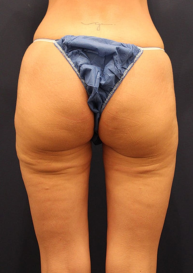 Thigh Lift Before & After