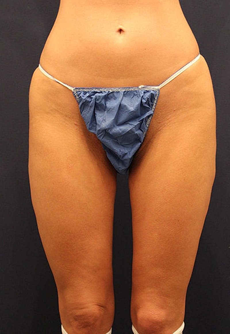 Thigh Lift Before & After