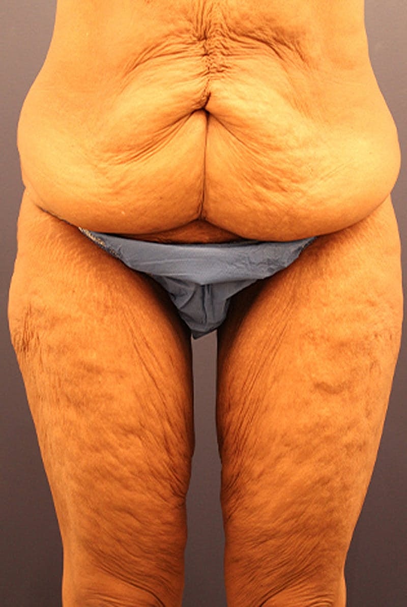 Thigh Lift Before & After