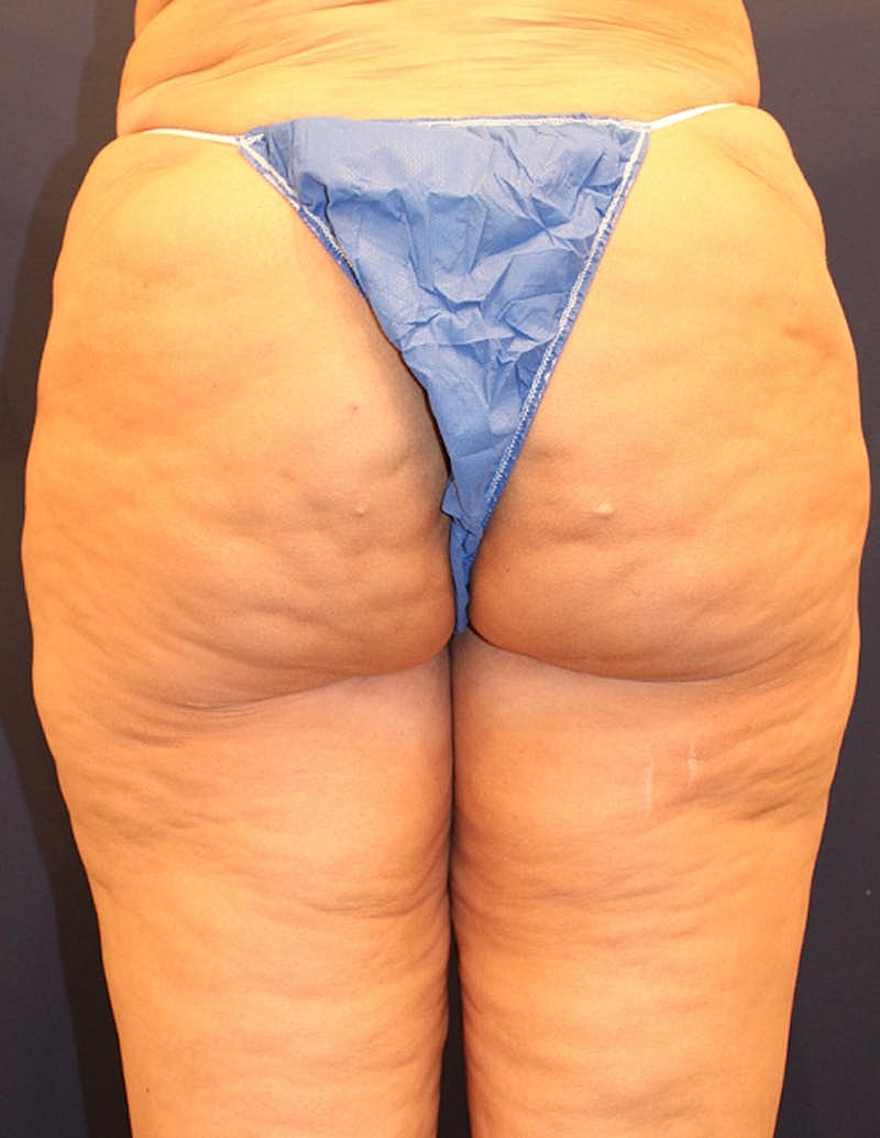 Thigh Lift Before & After