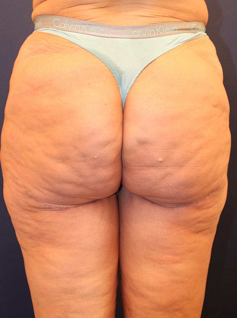 Thigh Lift Before & After