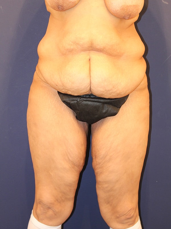 Thigh Lift Gallery Before & After