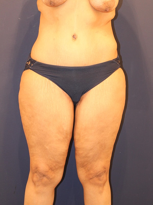 Thigh Lift Gallery Before & After