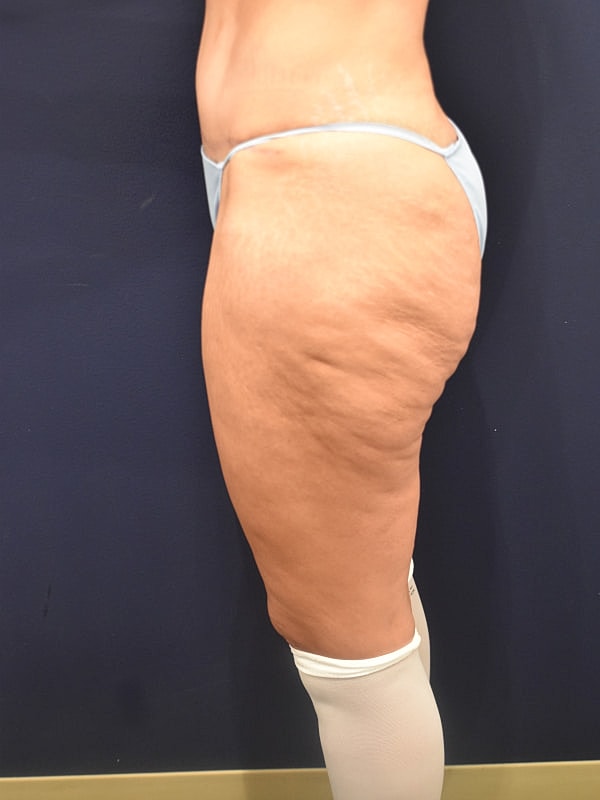 Thigh Lift Gallery Before & After