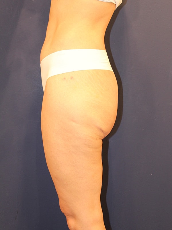 Thigh Lift Gallery Before & After