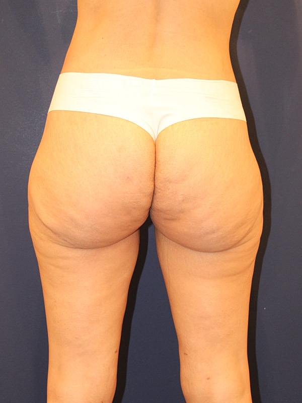 Thigh Lift Gallery Before & After