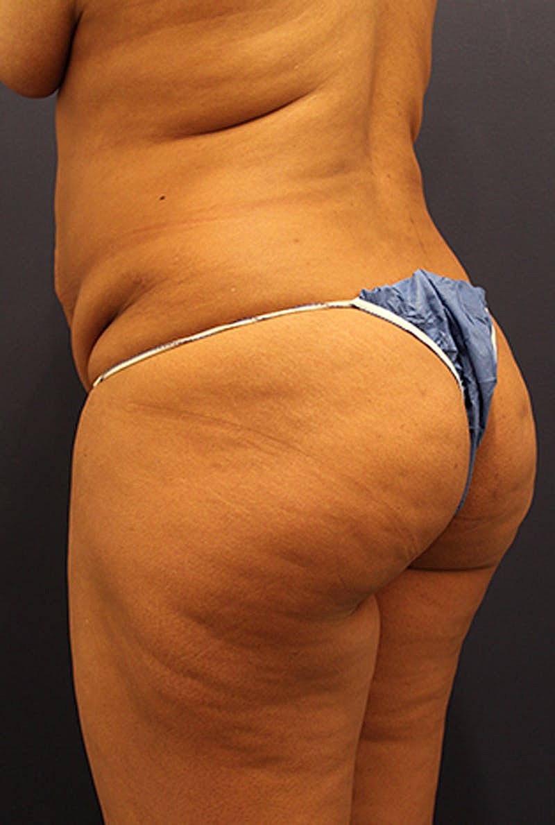 Buttock Fat Transfer Before & After
