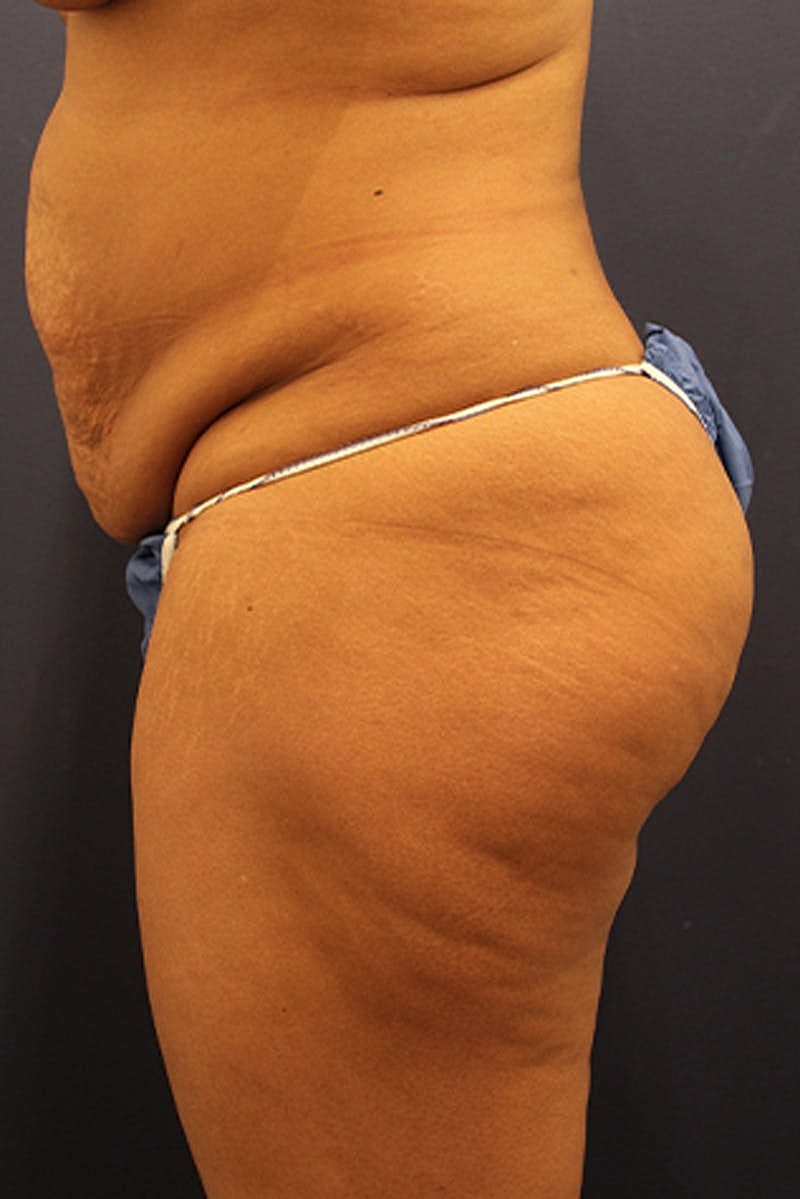 Buttock Fat Transfer Before & After