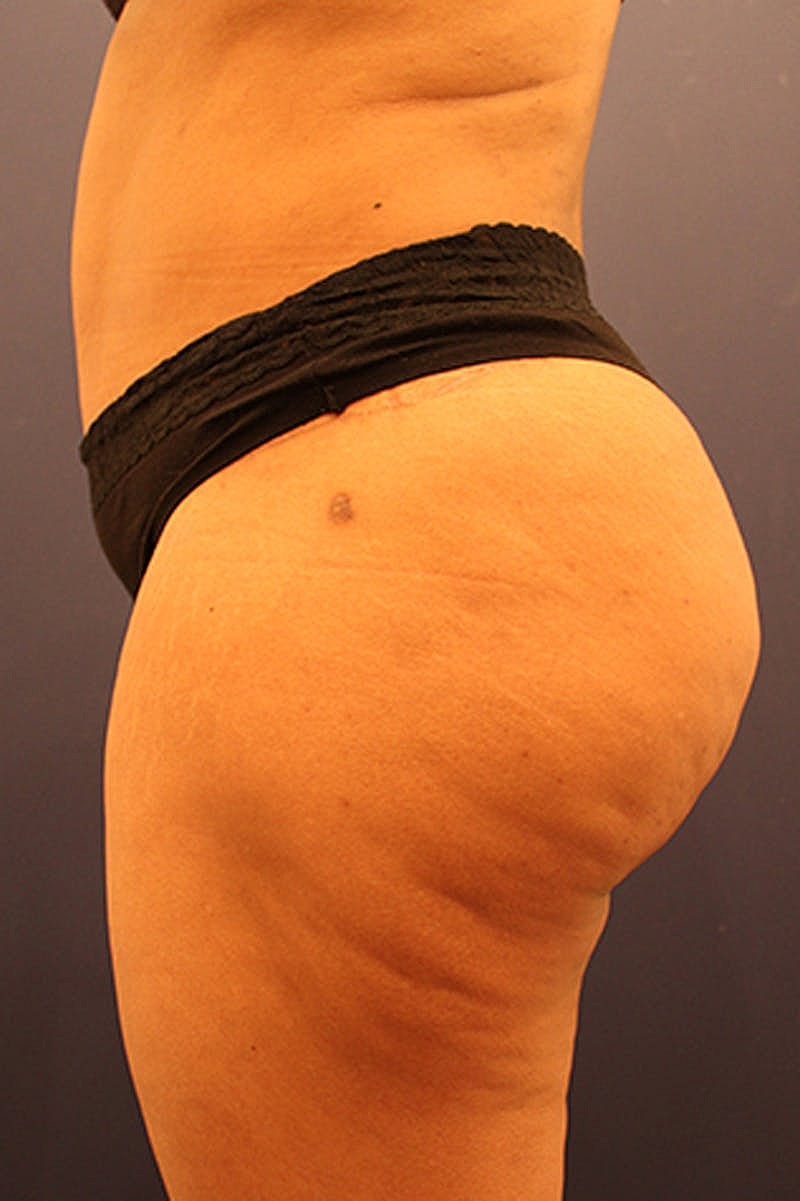 Buttock Fat Transfer Before & After