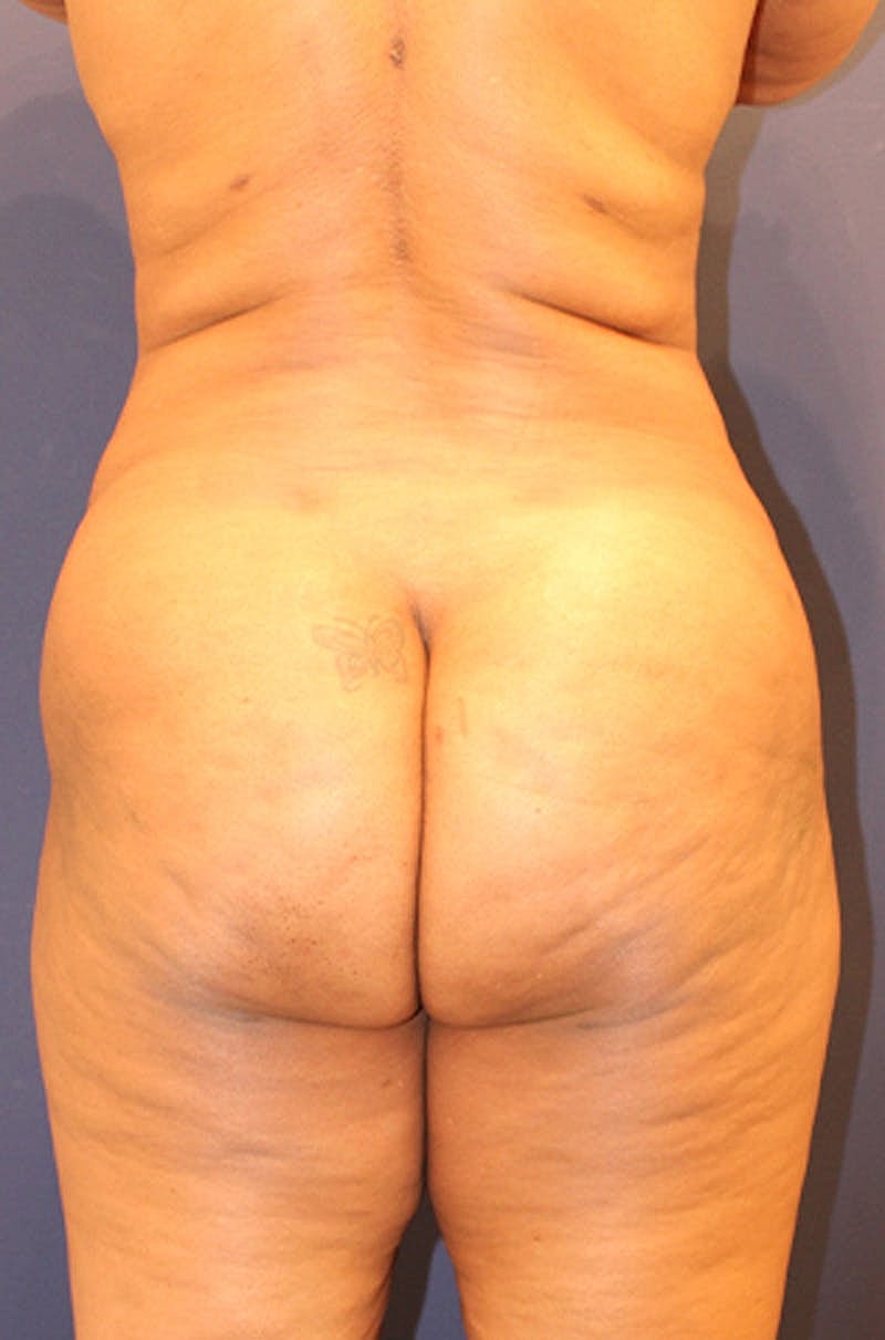 Buttock Fat Transfer Before & After