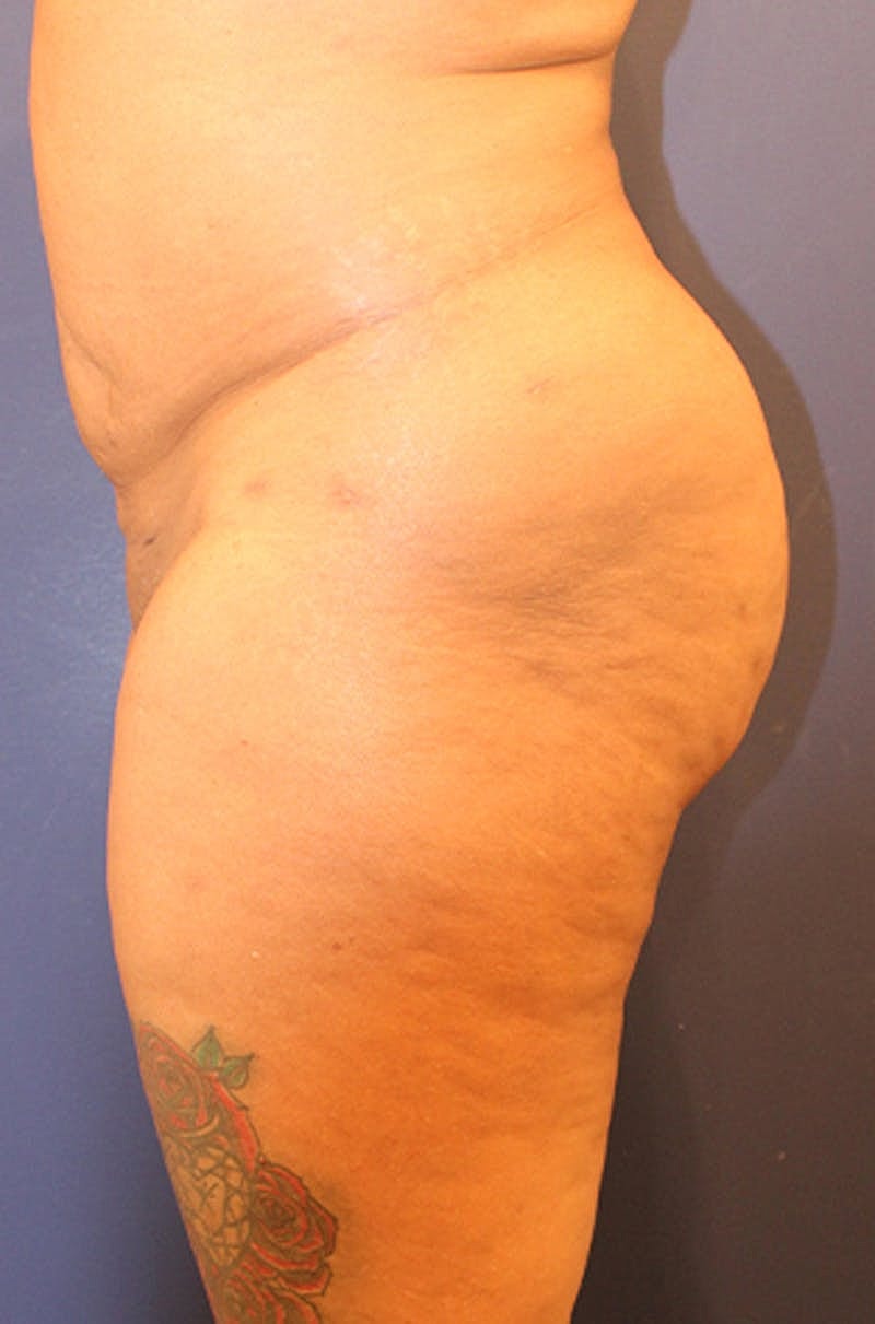 Buttock Fat Transfer Before & After