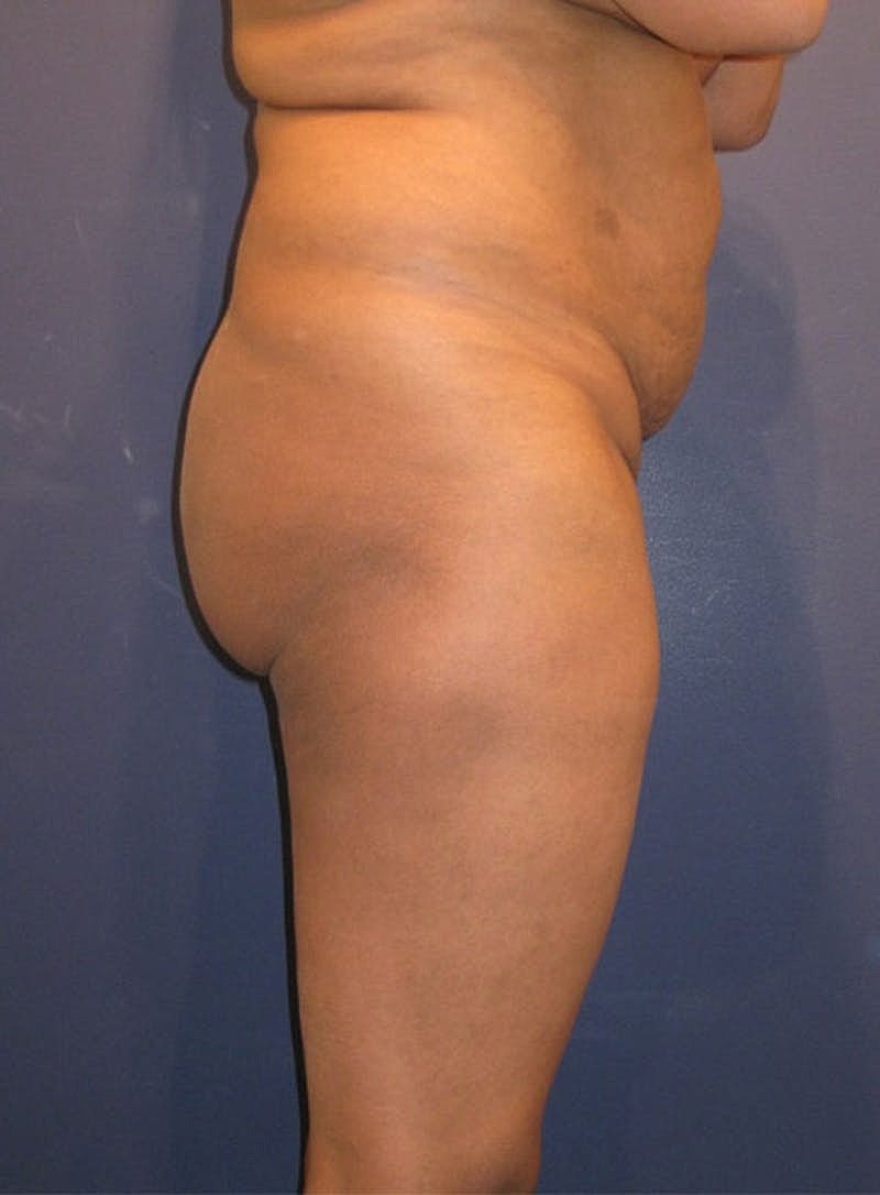 Buttock Fat Transfer Before & After