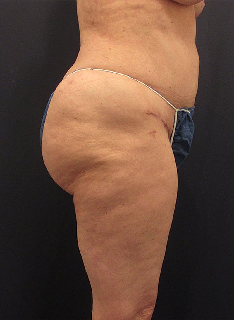 Buttock Fat Transfer Before & After