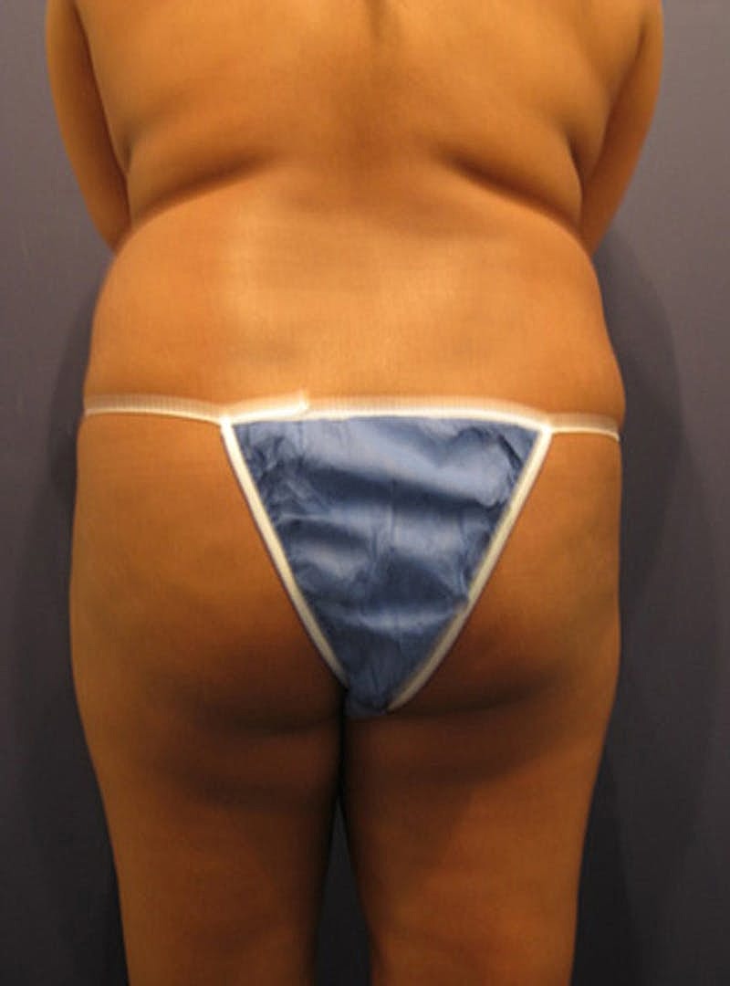 Buttock Fat Transfer Before & After