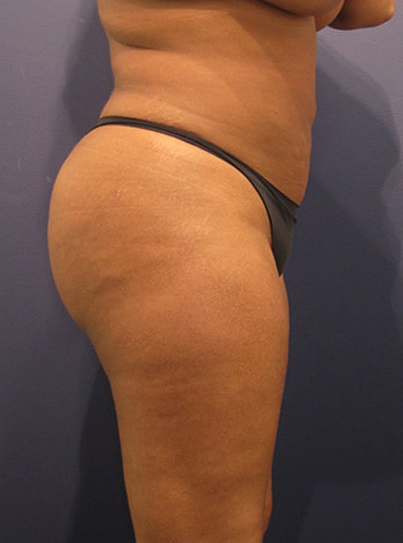 Buttock Fat Transfer Before & After