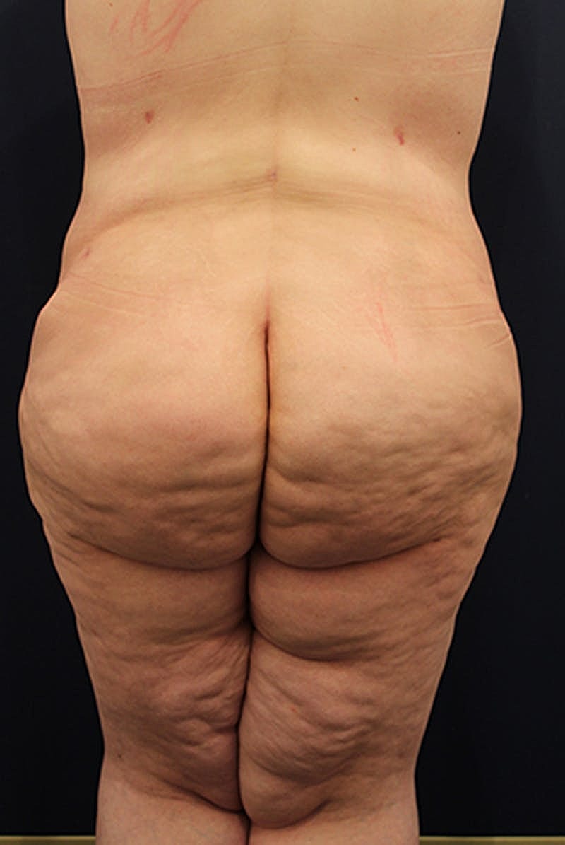 Buttock Fat Transfer Before & After