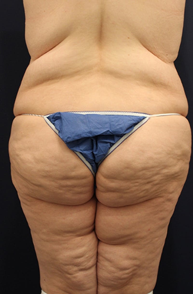 Buttock Fat Transfer Before & After