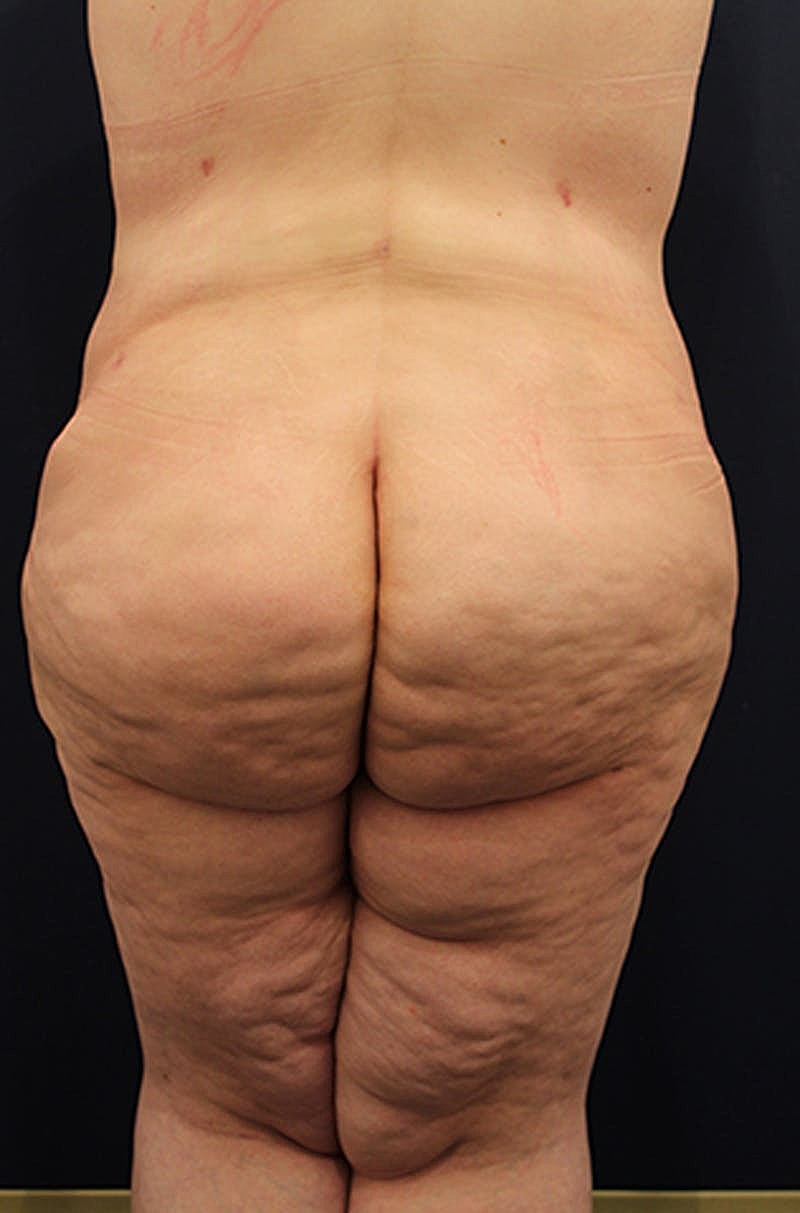Buttock Fat Transfer Before & After
