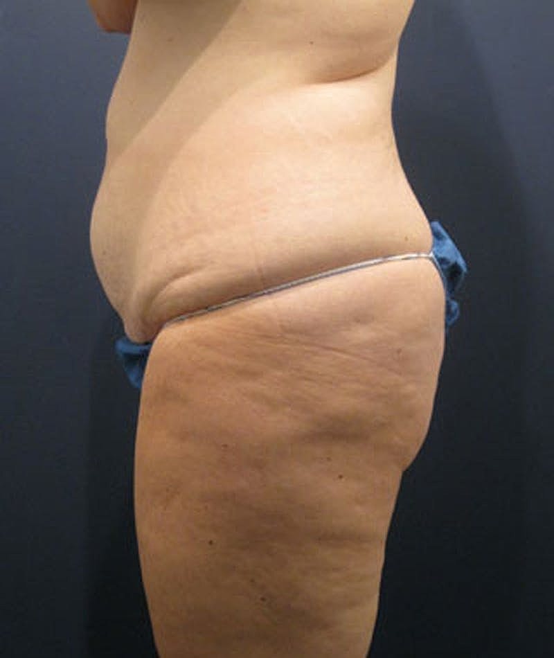 Buttock Fat Transfer Before & After