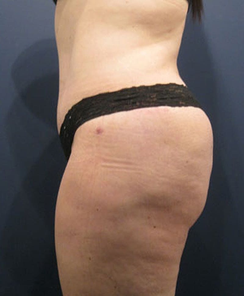 Buttock Fat Transfer Before & After